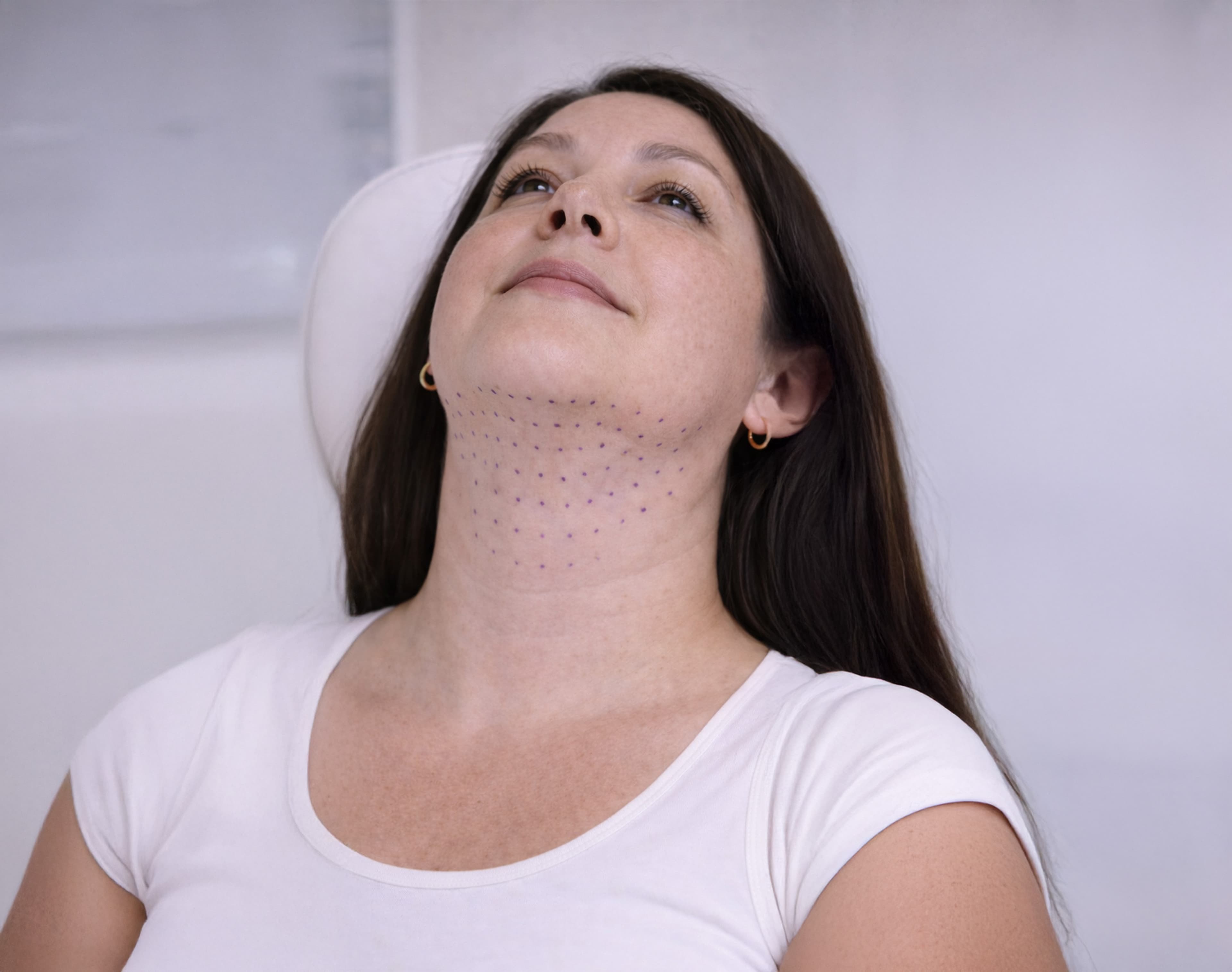 Enzymatic Remodeling Therapy – Localized fat reduction and fibrosis breakdown using targeted enzyme therapy for smoother contour and improved skin texture.