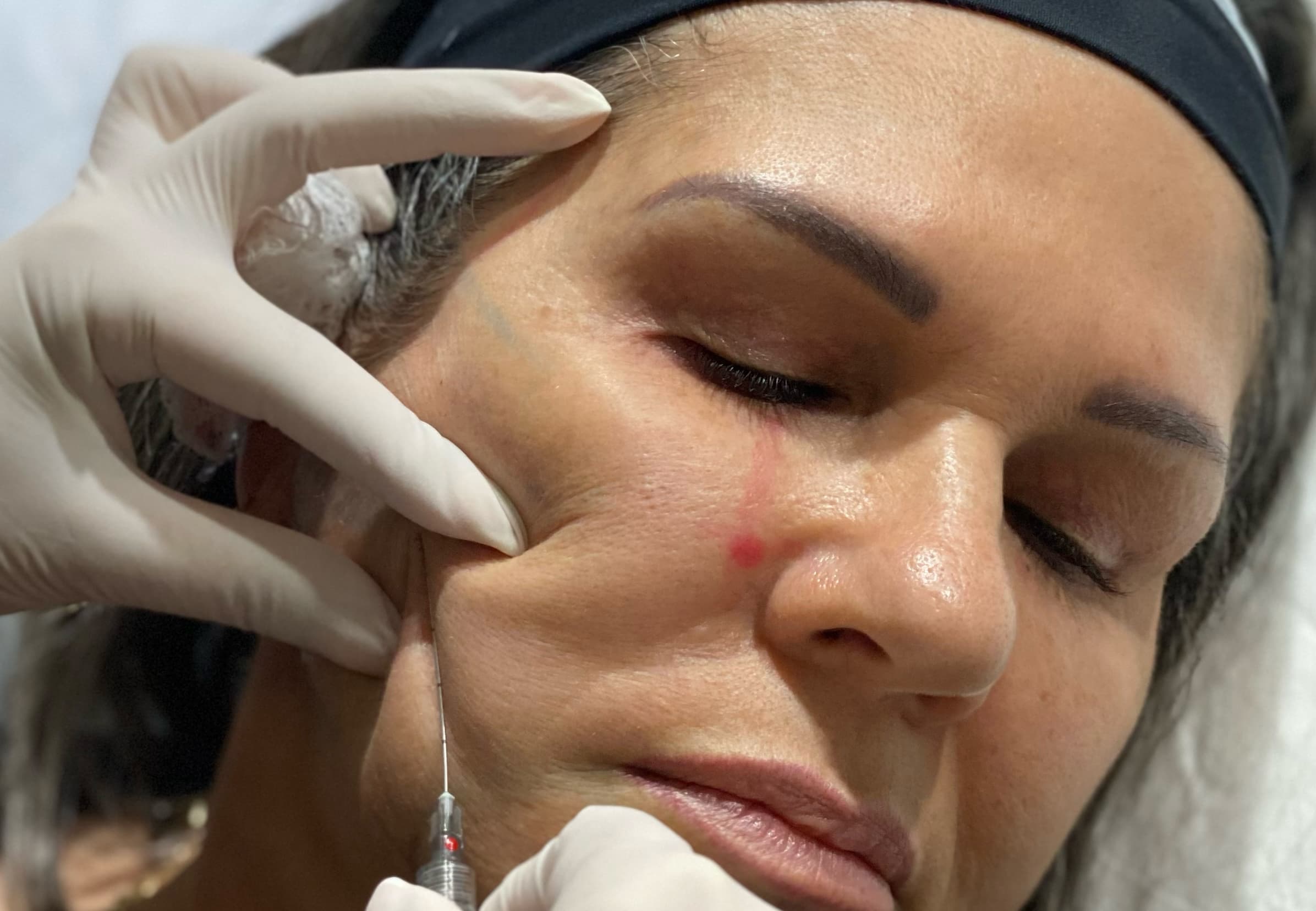 Facial Balancing with Dermal Fillers – Achieve natural facial harmony with strategic dermal filler placement targeting the cheeks, chin, jawline, and midface. Ideal for restoring symmetry, contour, and volume loss.