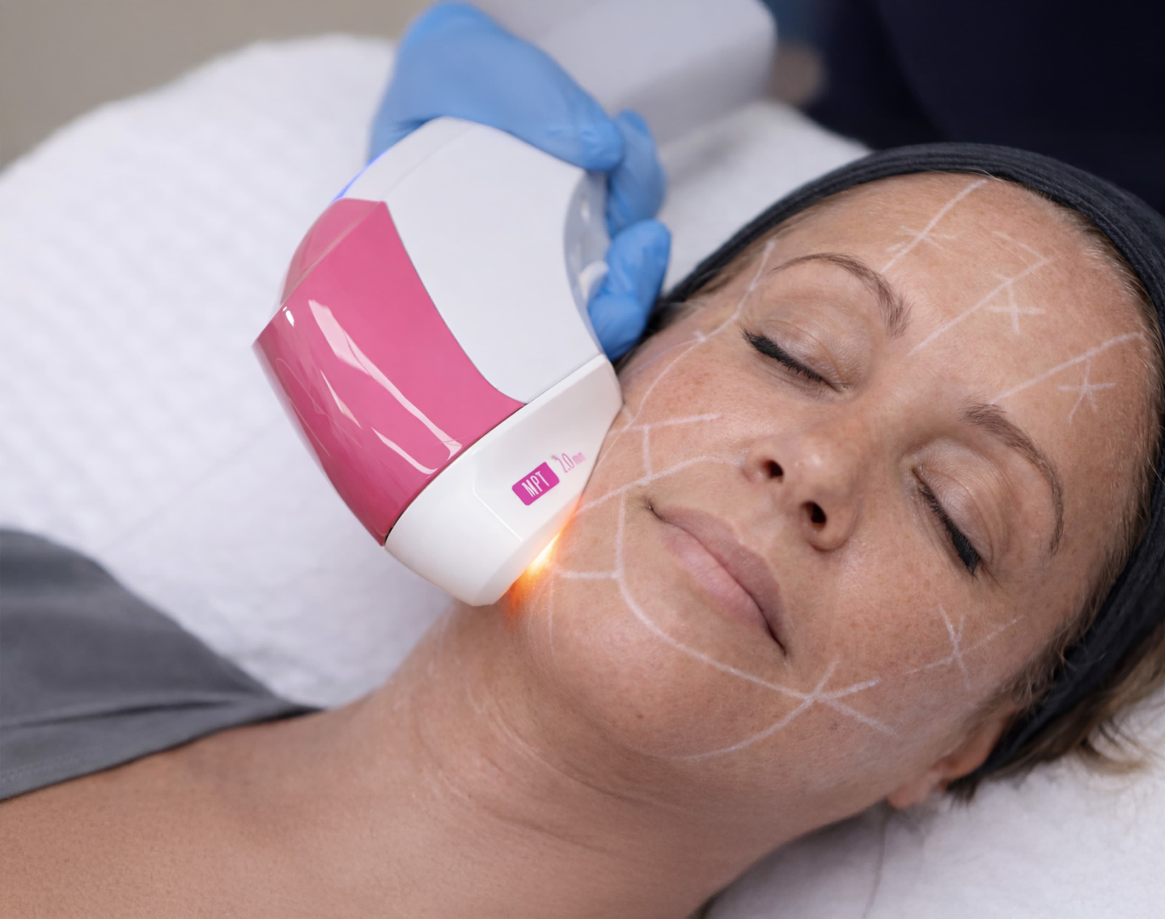 Ultraformer MPT HIFU Lift