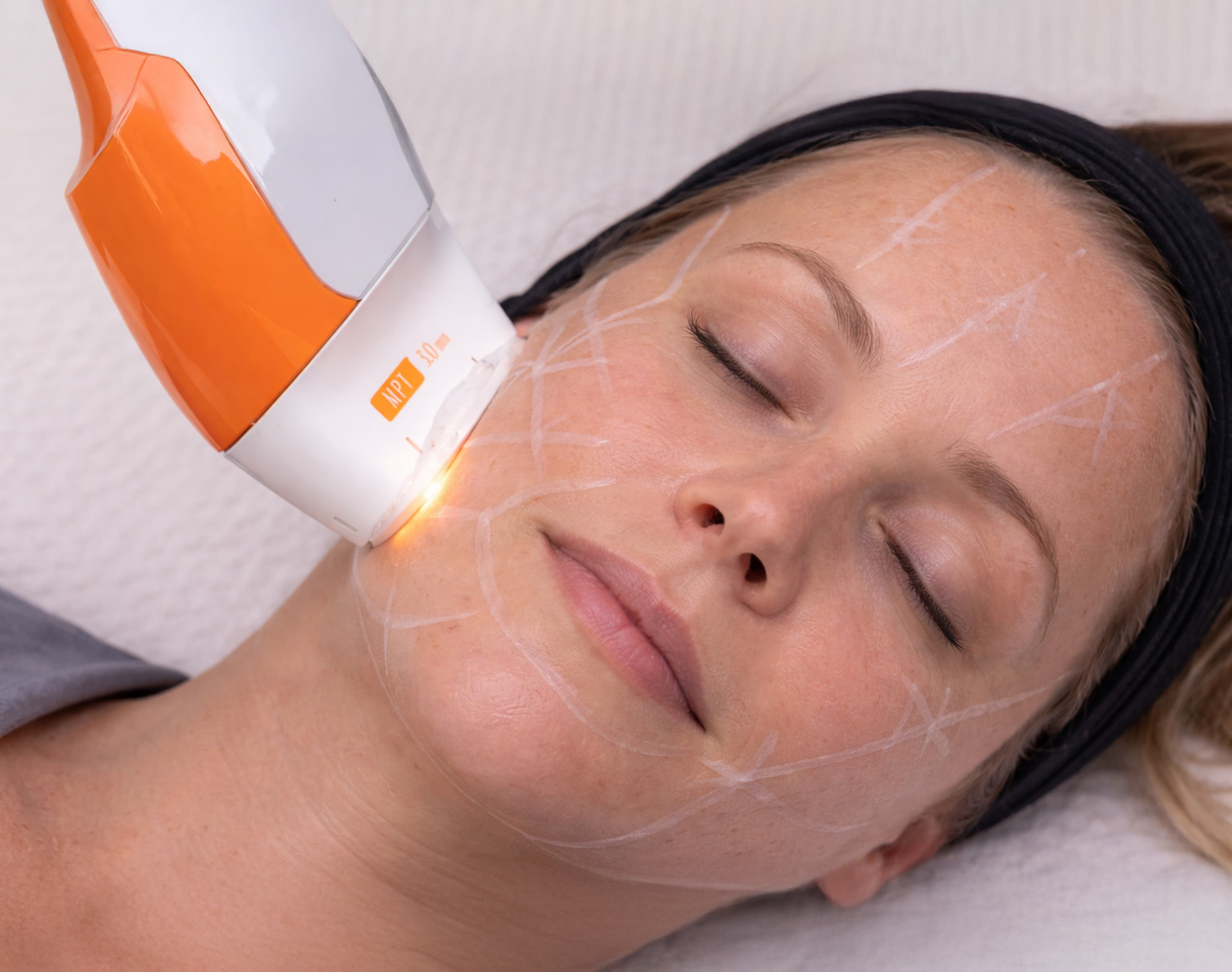 Treatment image for Ultraformer MPT HIFU Lift