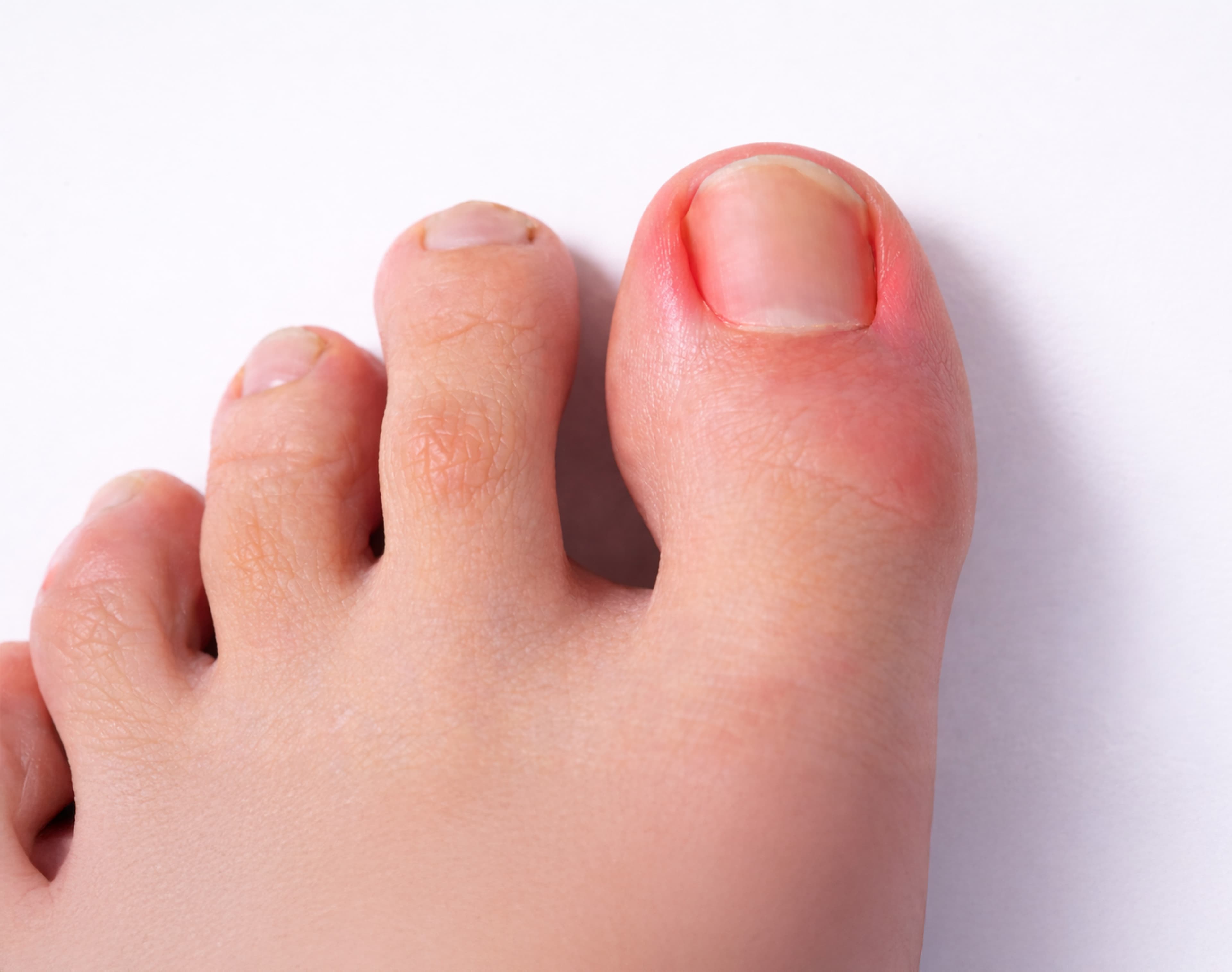 Matrixectomy – Surgical removal of part of the nail matrix to permanently prevent ingrown toenails and recurring infections.