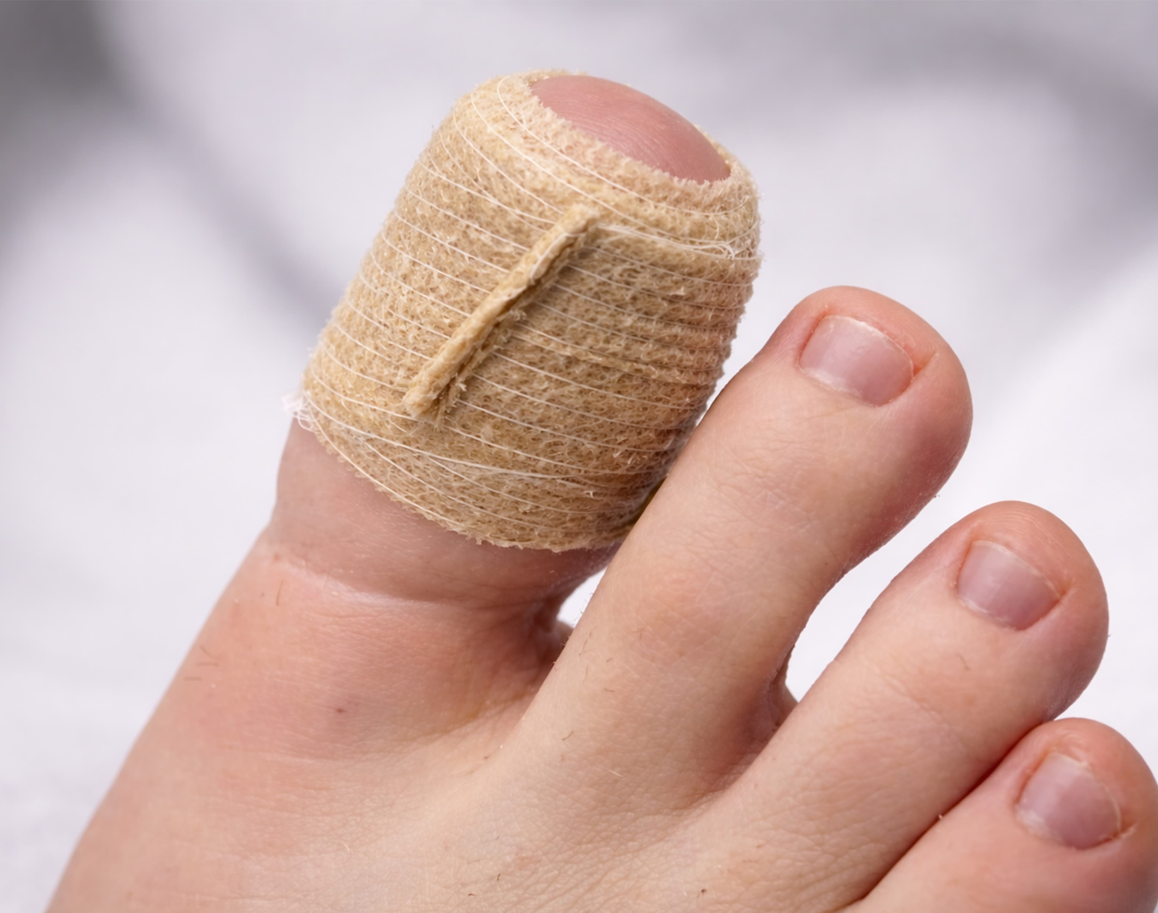 Treatment image for Matrixectomy