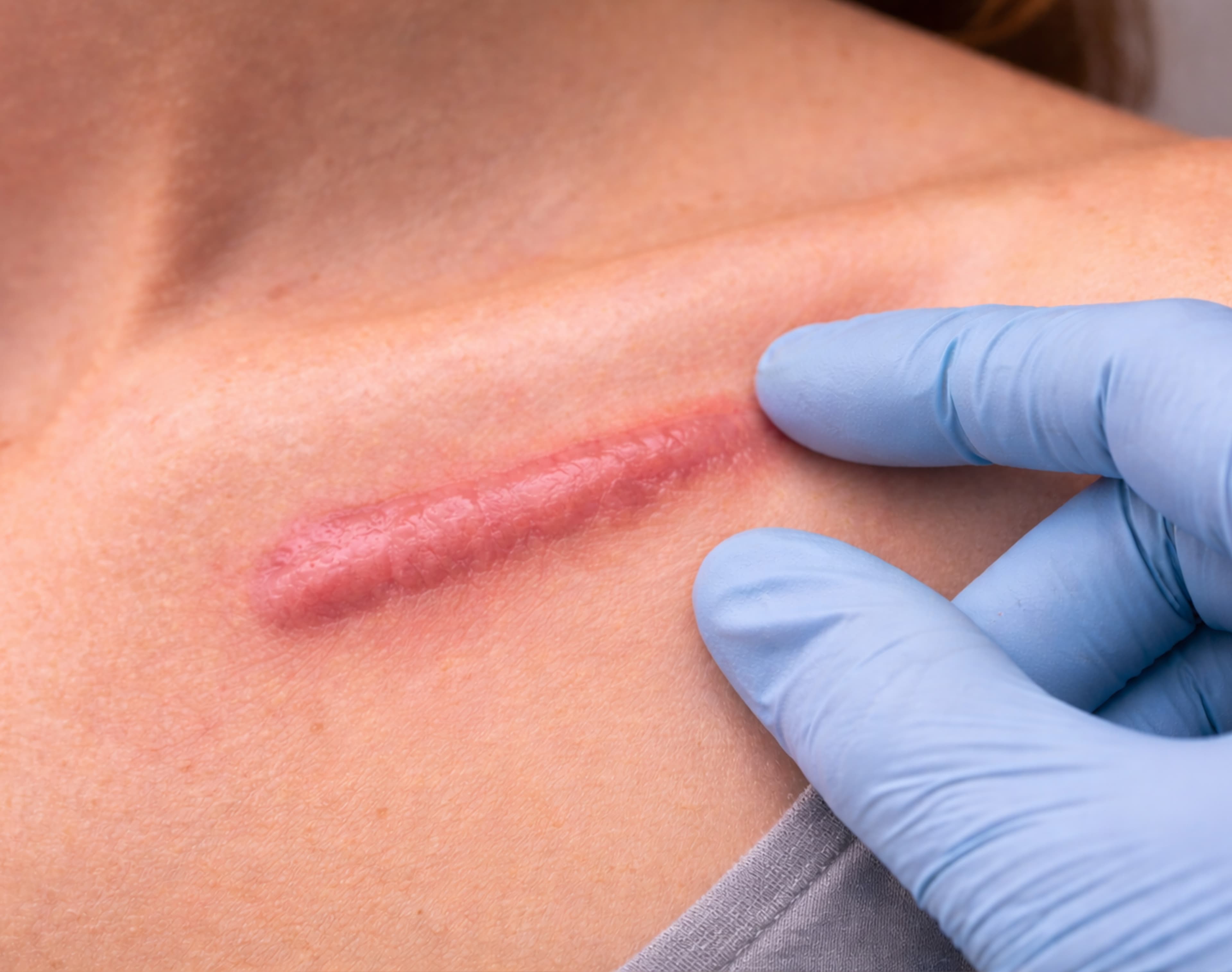 Keloid Scar Injection – Targeted corticosteroid or anti-fibrotic injections to flatten and soften raised keloid scars.