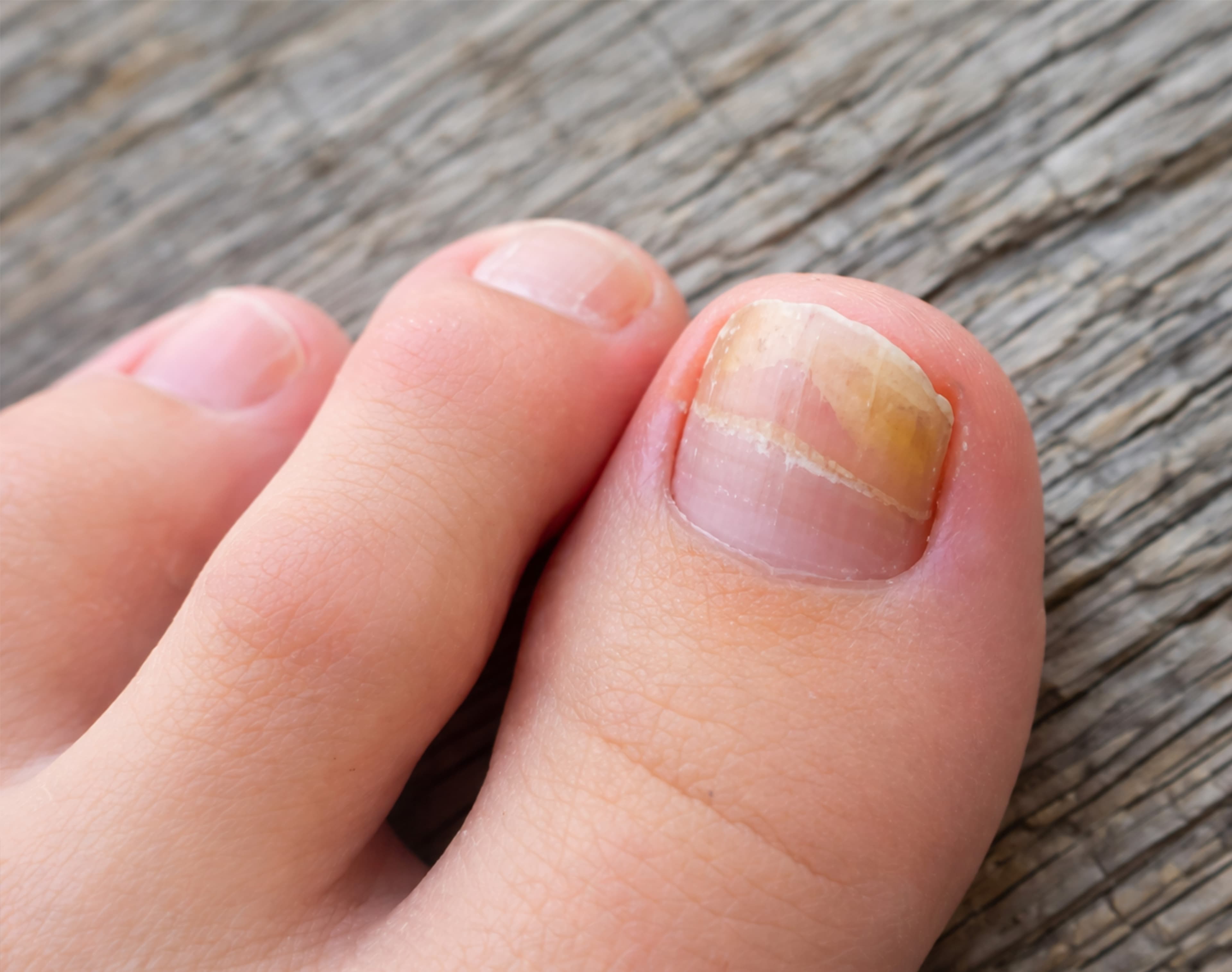Laser Nail Fungus Treatment – Non-invasive laser therapy to eliminate toenail fungus and restore nail clarity without pain or medication.
