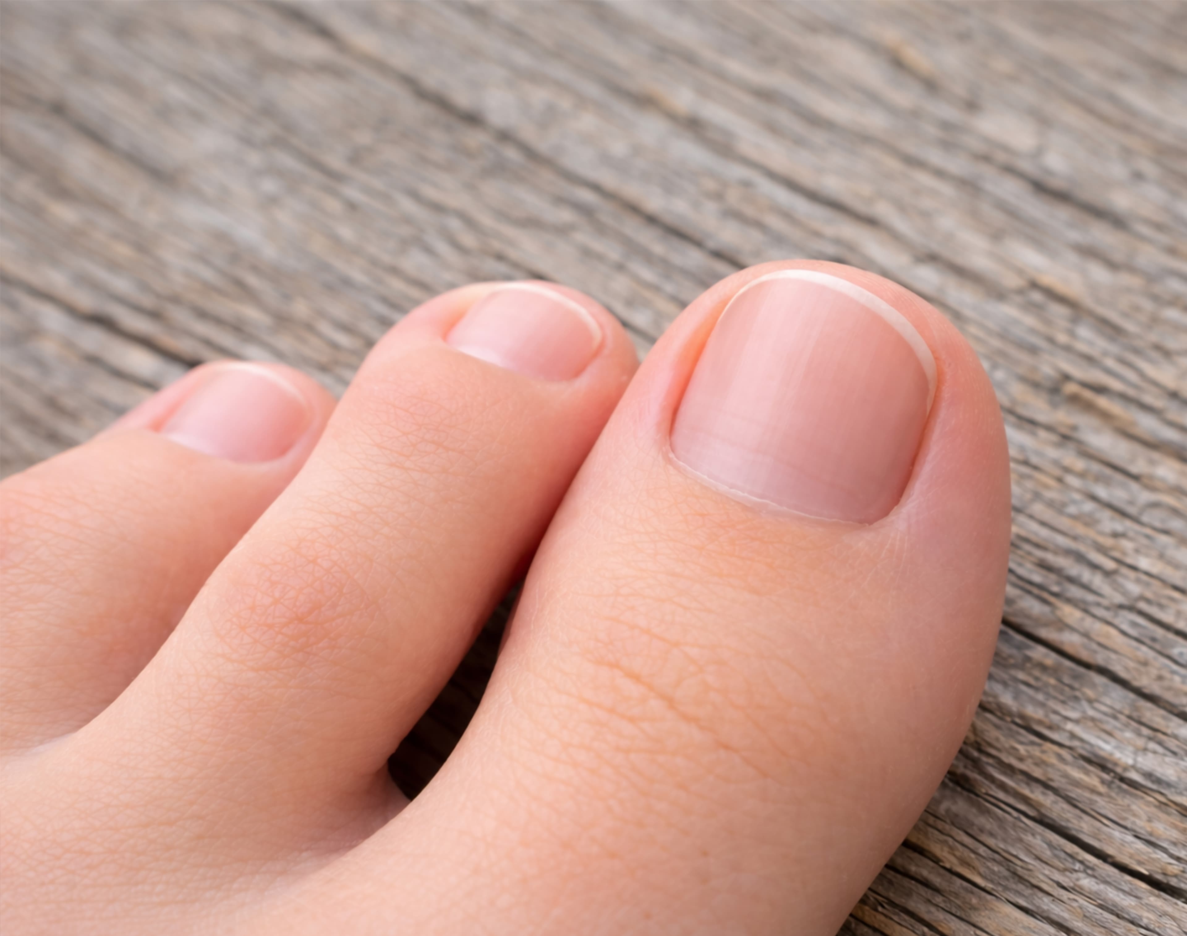 Treatment image for Laser Nail Fungus Treatment