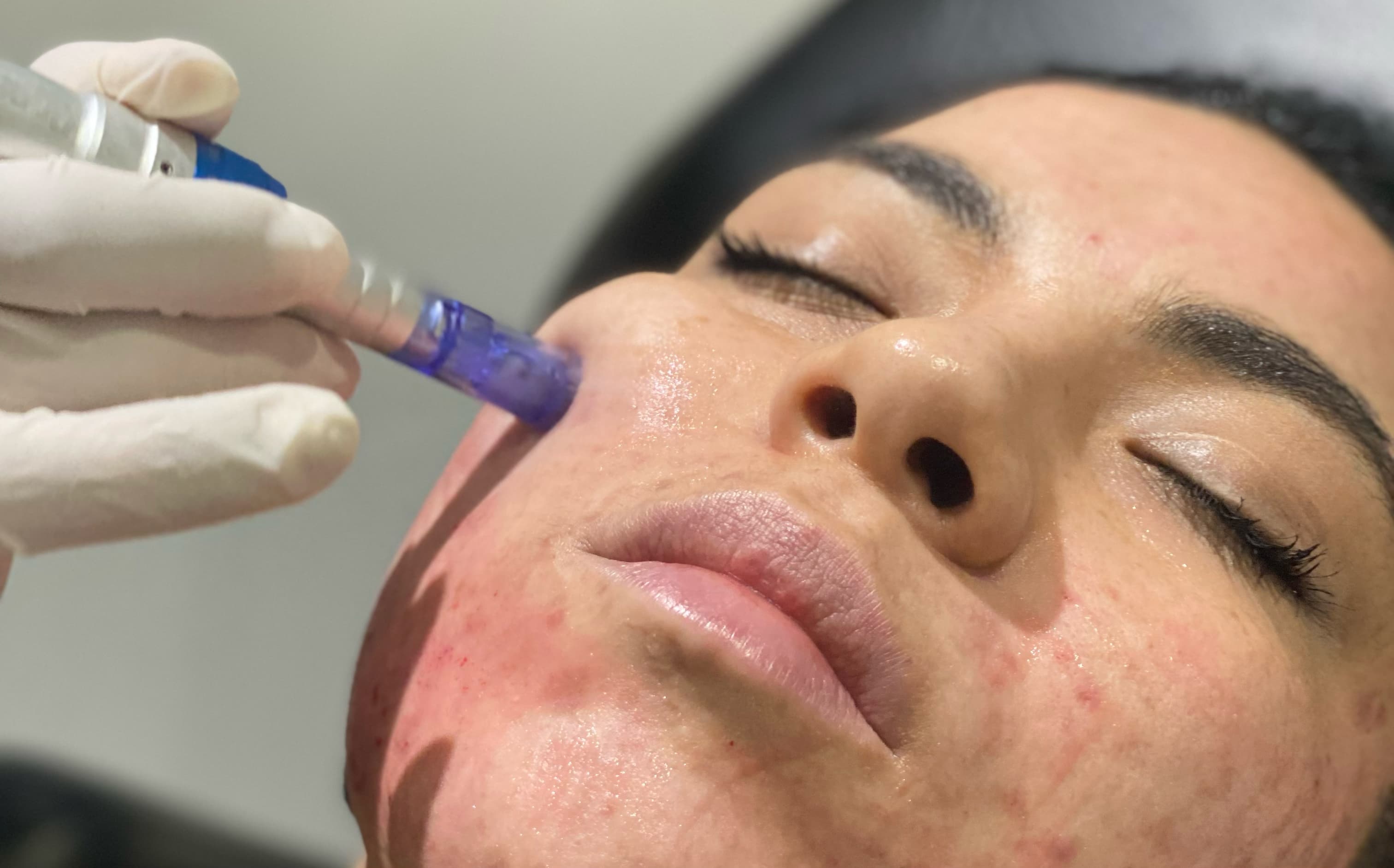 Microneedling Skin Renewal – Refine texture, minimize pores, and stimulate collagen through precision microneedling using fine sterile needles. Choose PRP/PRFM for glow and repair, PN for hydration and regeneration, PDRN for recovery and tone, or Toskani® and Caviar Extract infusions for targeted skin renewal.