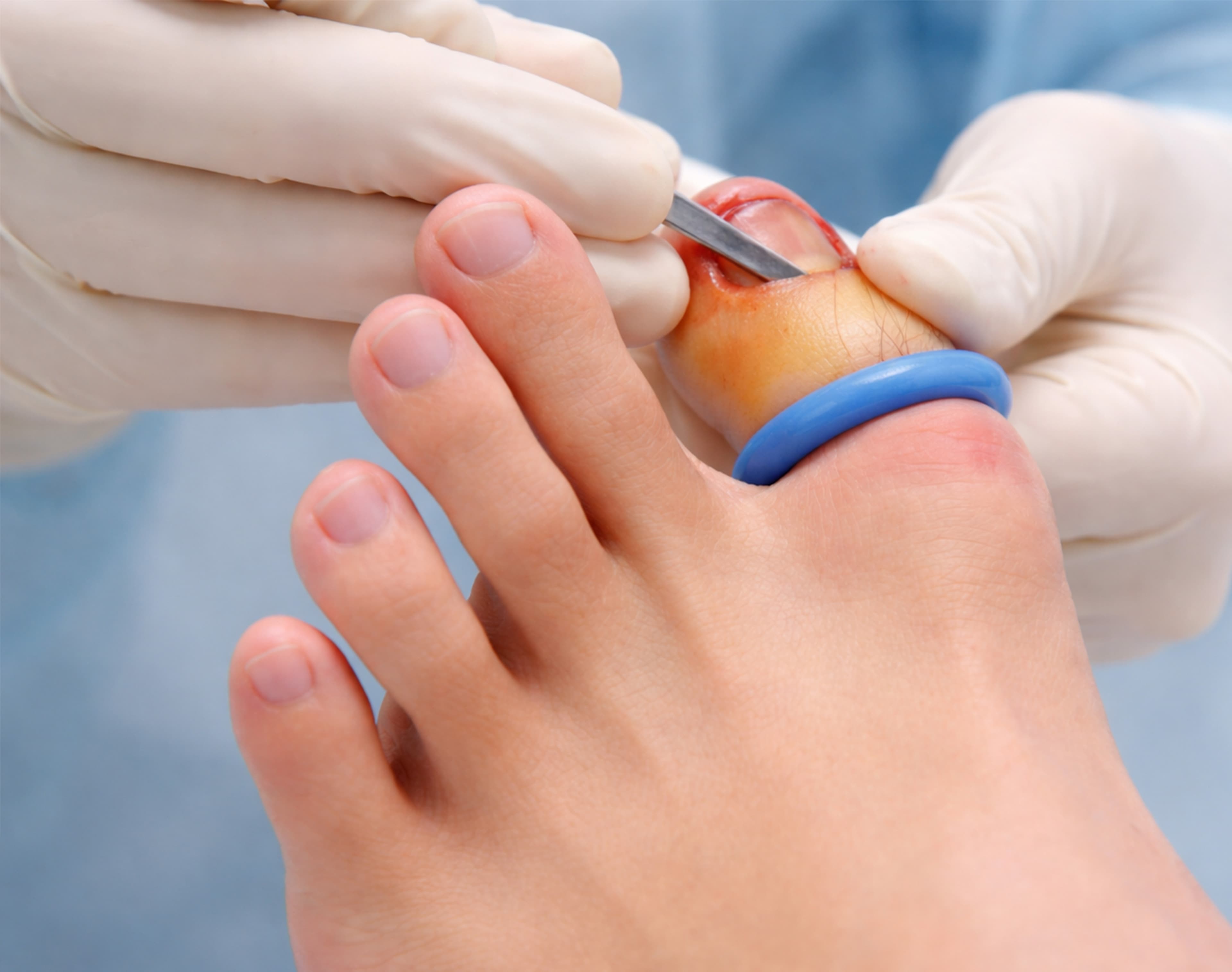 Toenail Extraction Procedure – Partial or total nail removal to treat severely ingrown, infected, or damaged toenails with long term relief.