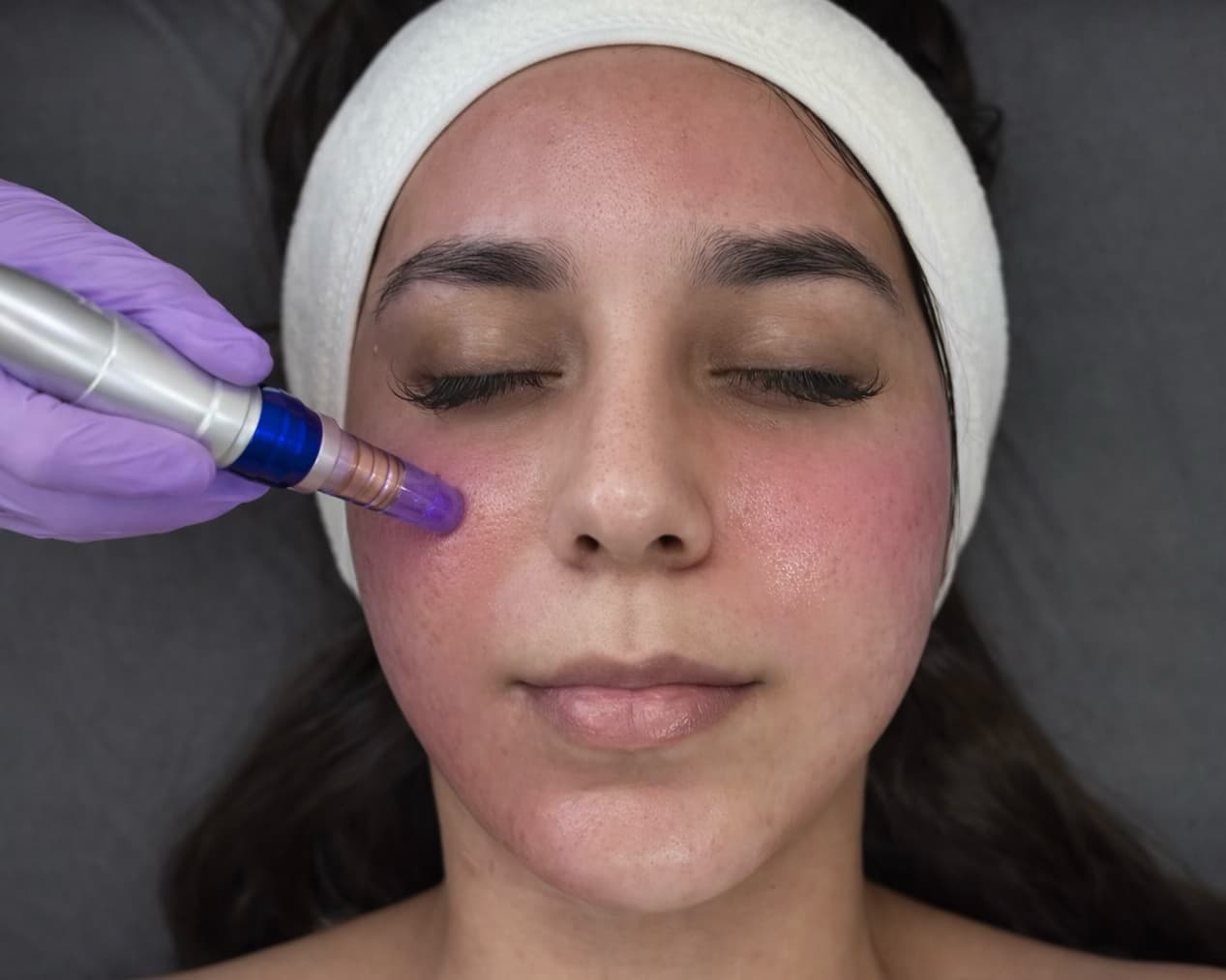 Treatment image for Microneedling Skin Renewal with PDRN