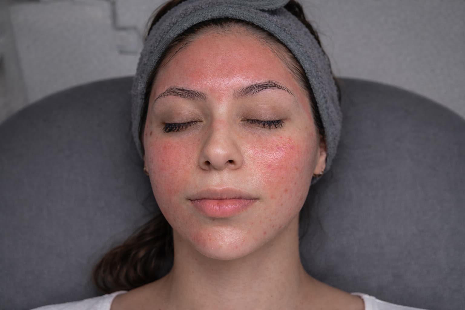 Treatment image for Microneedling Skin Renewal with Polynucleotides (PN)