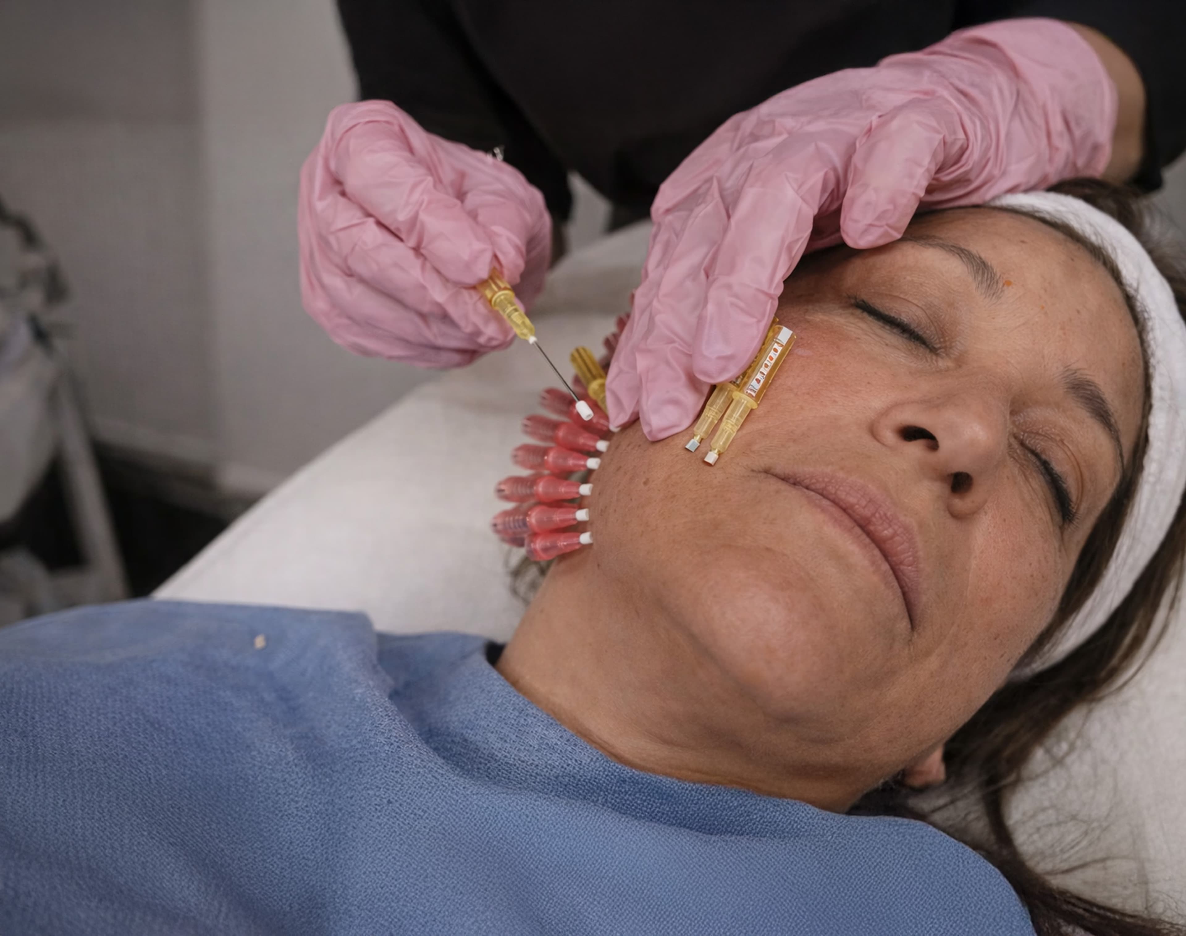 PDO Threads - Biostimulating Treatment Plan