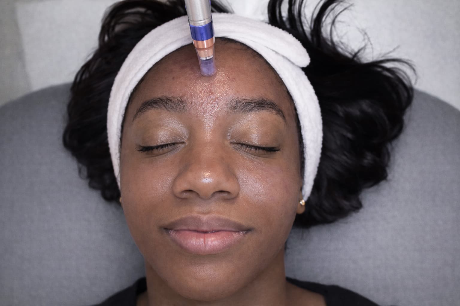 Treatment image for Microneedling Skin Renewal by Toskani
