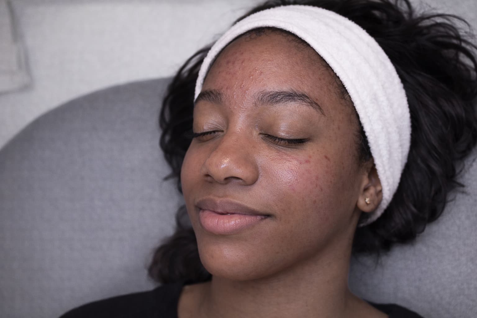 Treatment image for Microneedling Skin Renewal by Toskani