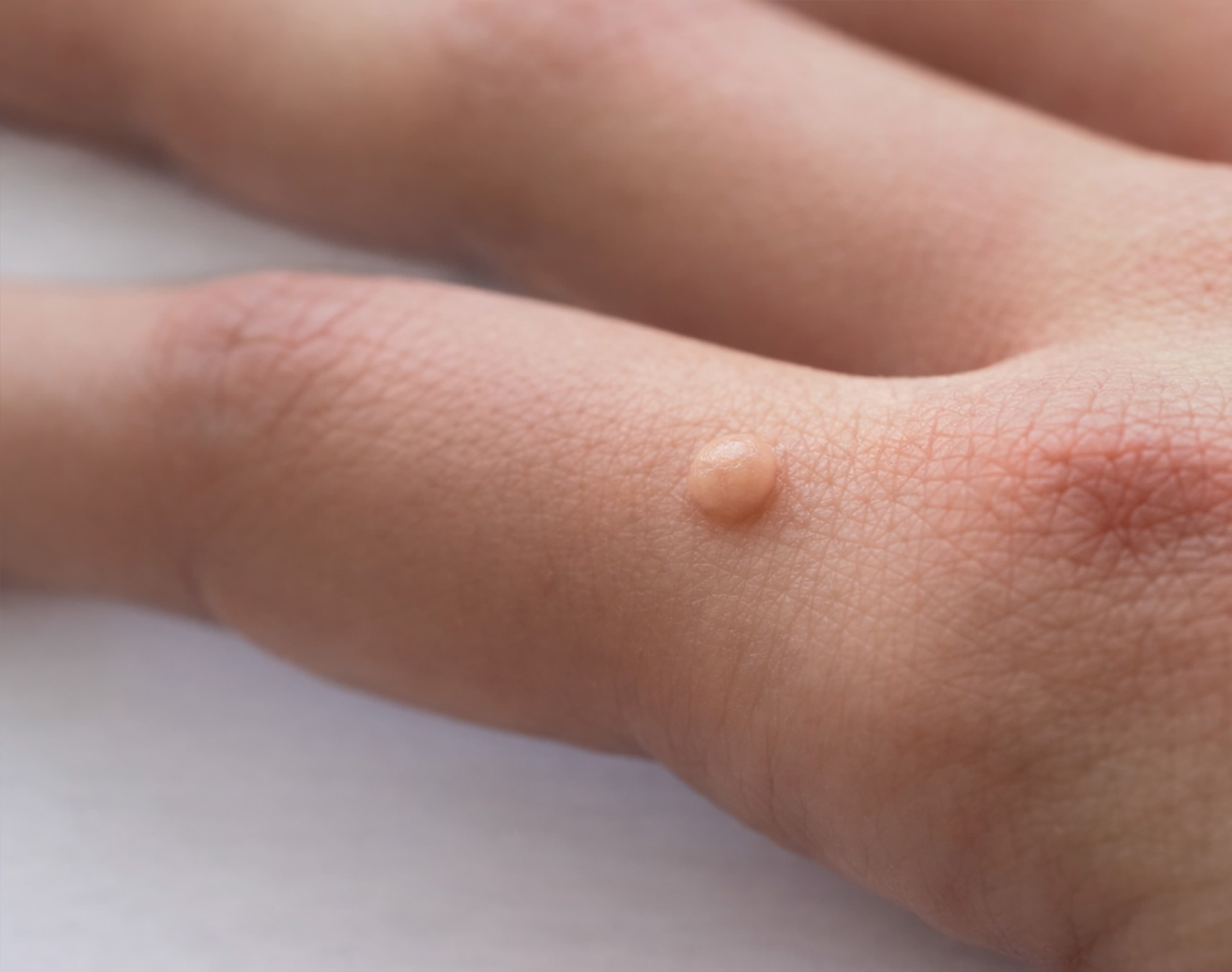 Wart / Skin Tag Removal – Safe and effective removal of warts and skin tags using advanced medical techniques for clear, smooth skin.