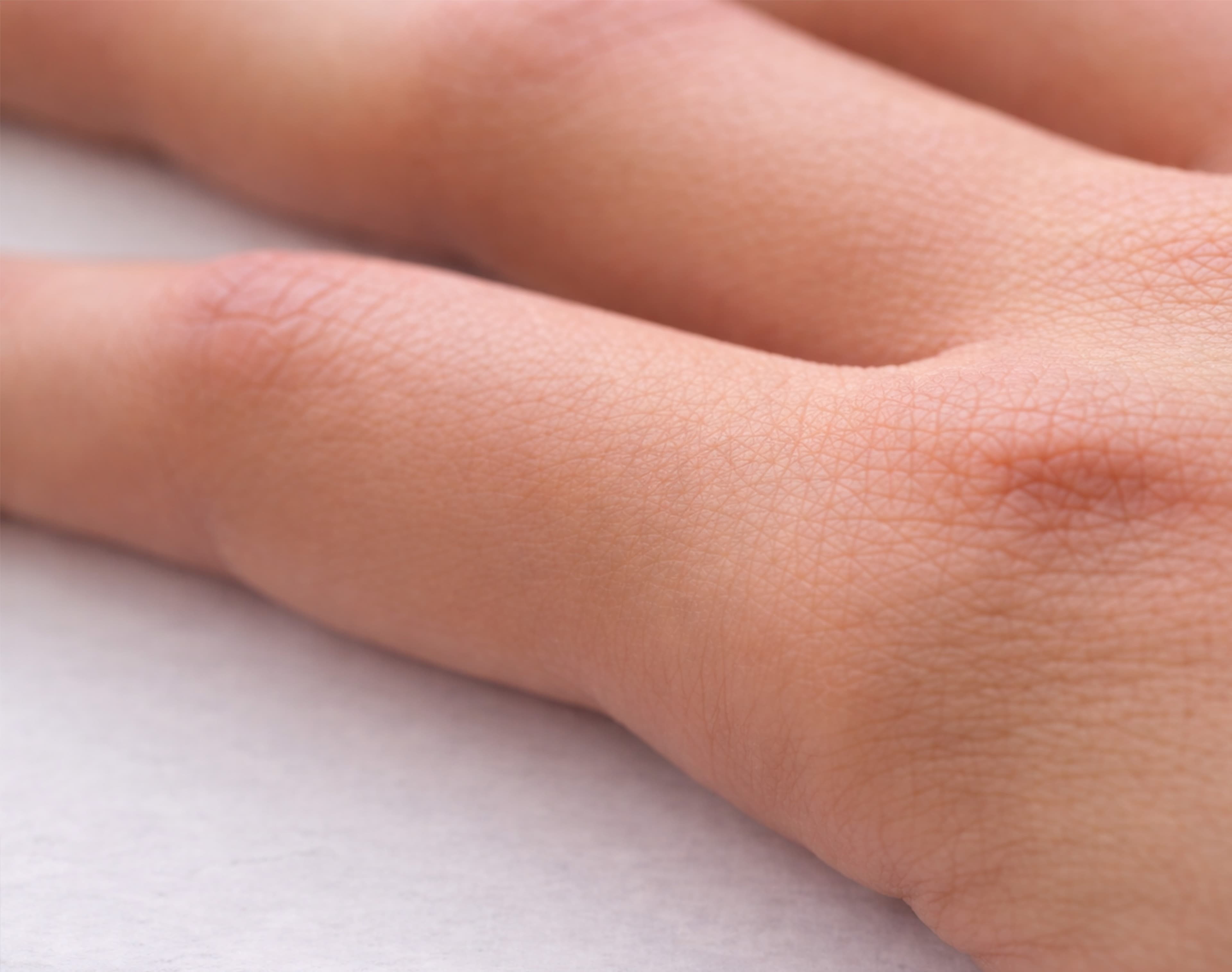 Treatment image for Wart / Skin Tag Removal