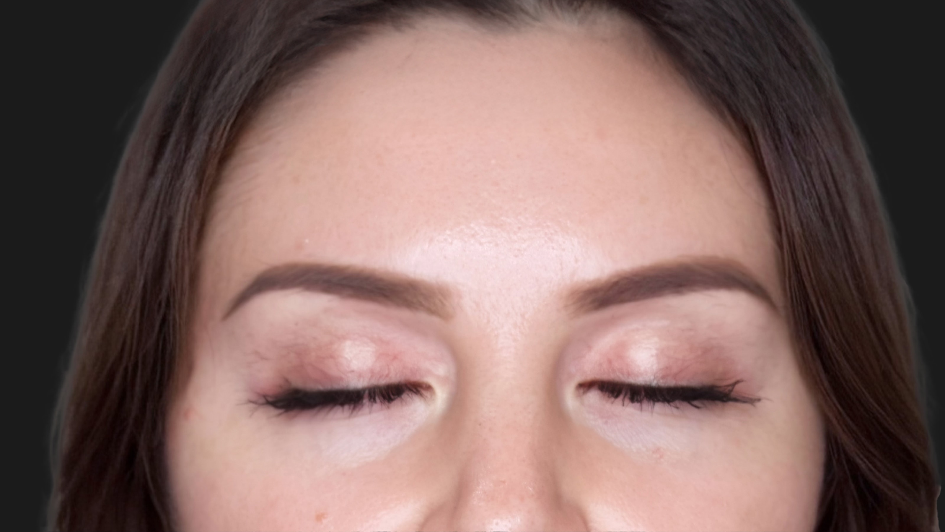 French Bio-Revitalization Therapy After