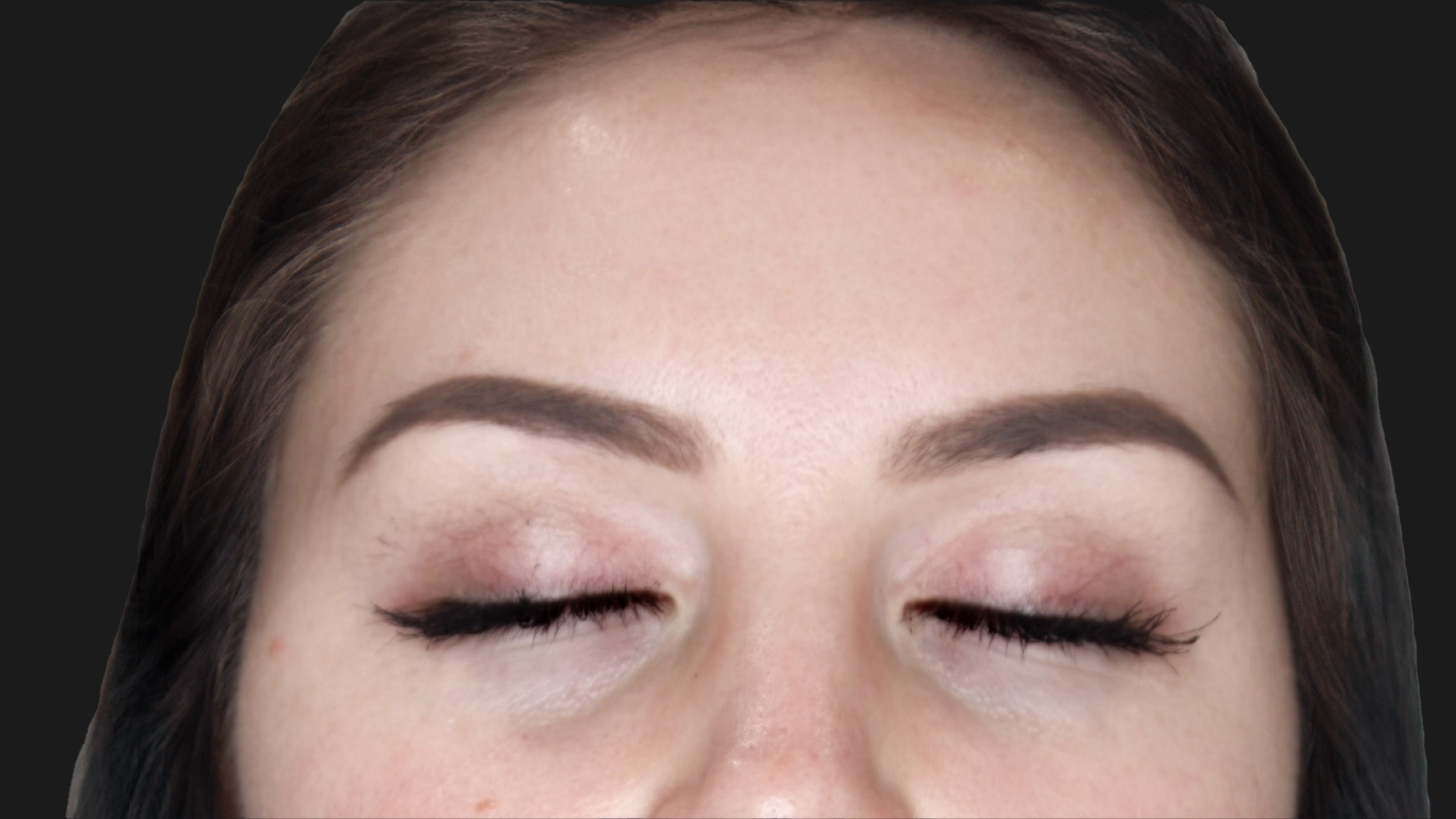 French Bio-Revitalization Therapy Before