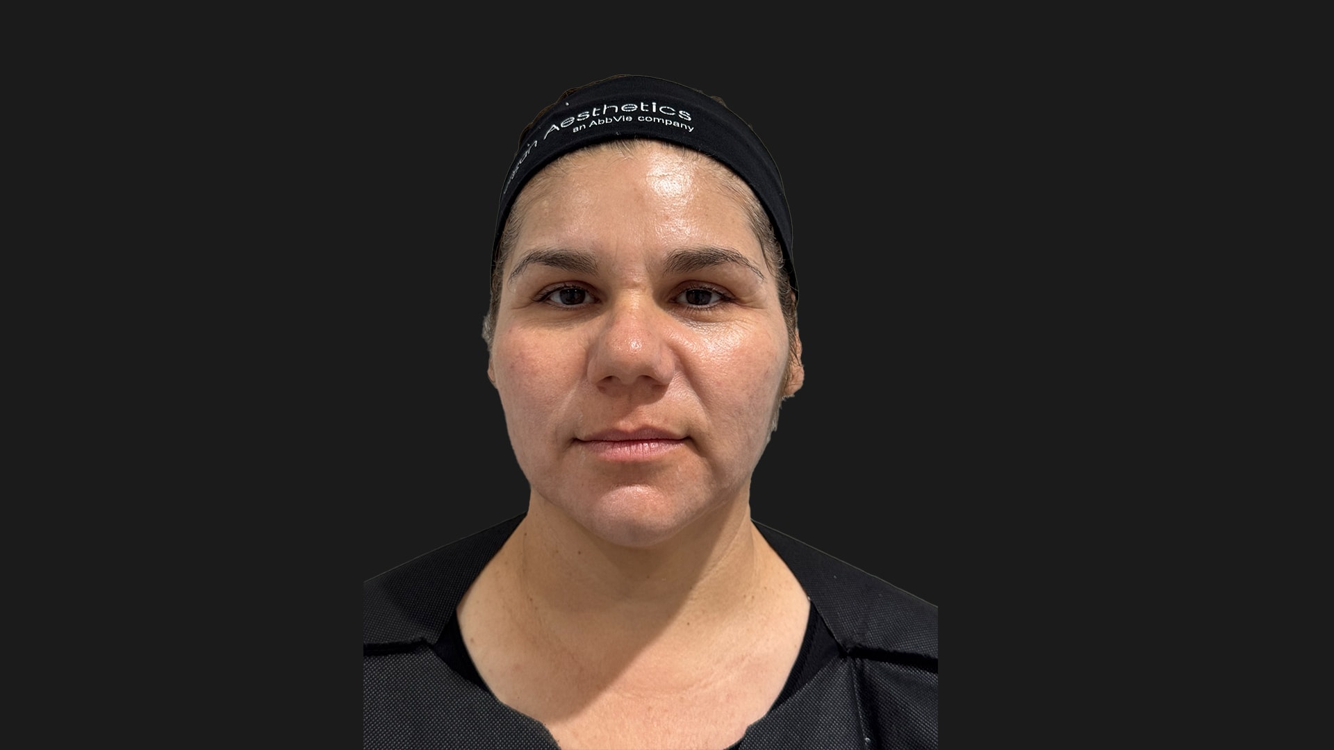 Facial Balancing with Dermal Fillers After