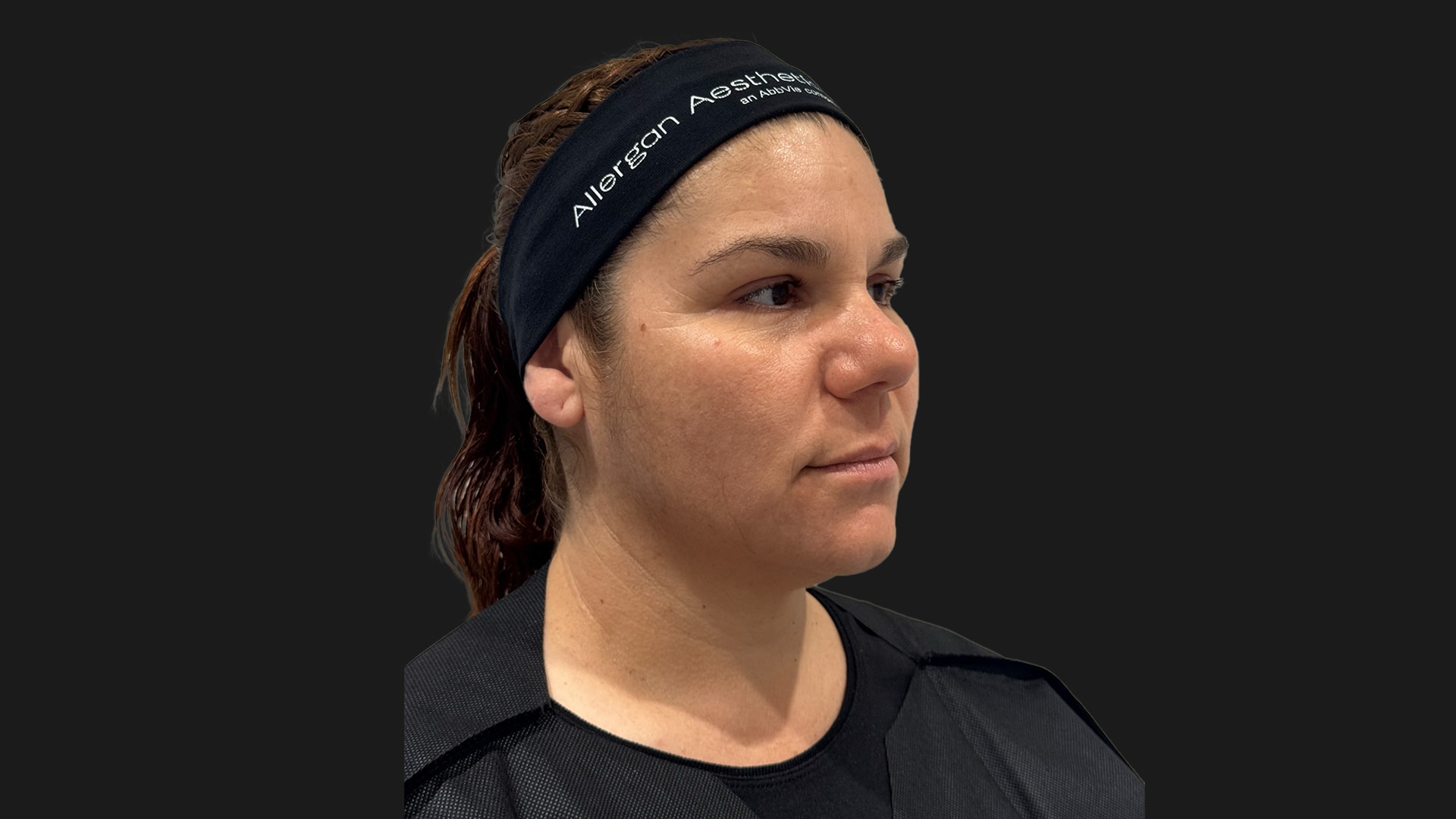 Facial Balancing with Dermal Fillers Before