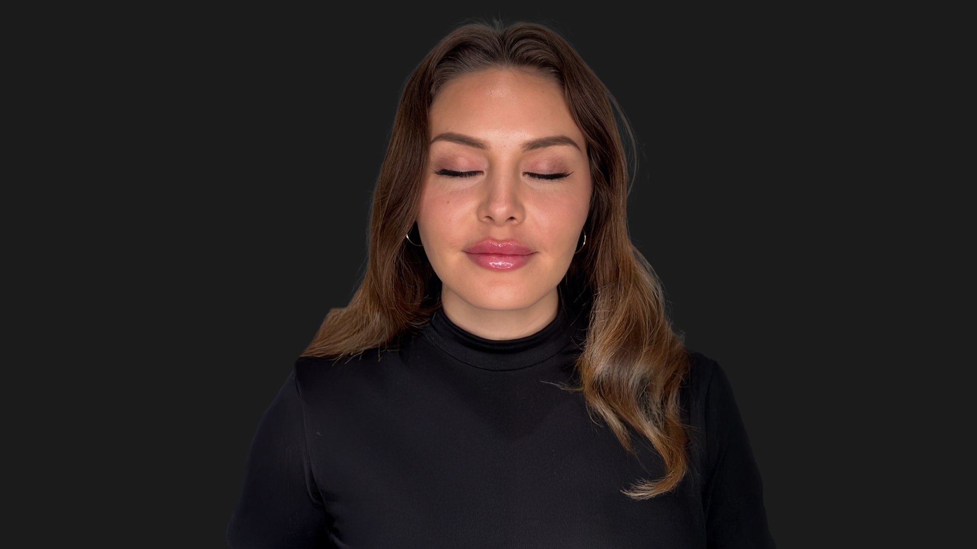 Lip Rejuvenation & Sculpting After