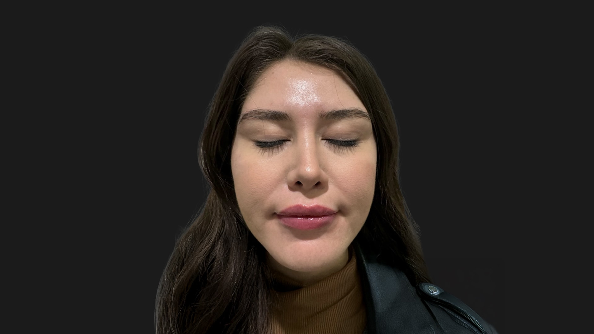 Lip Rejuvenation & Sculpting After