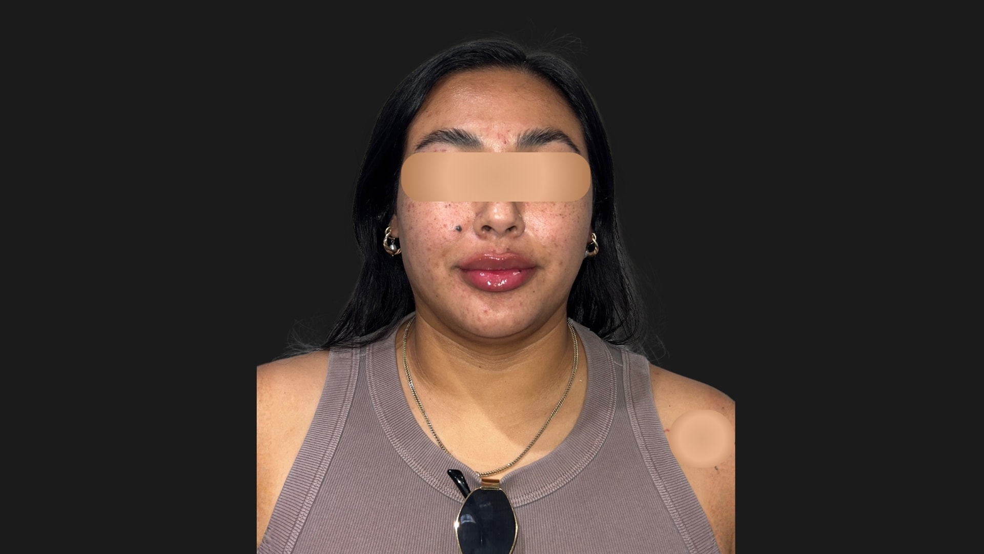 Lip Rejuvenation & Sculpting After