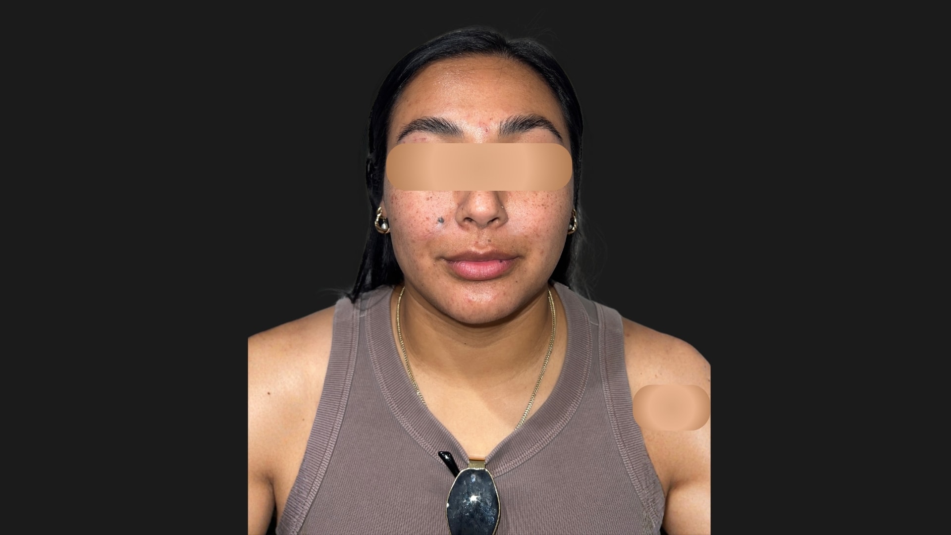 Lip Rejuvenation & Sculpting Before