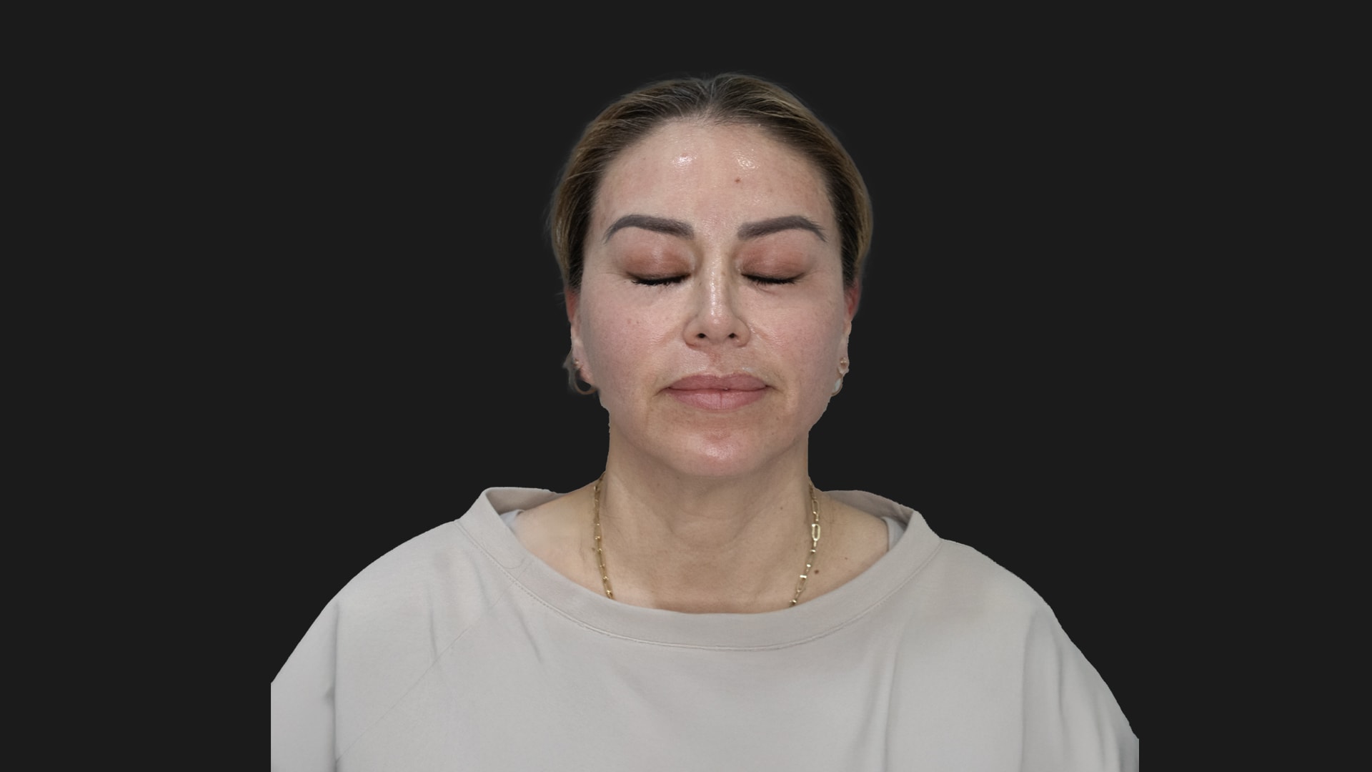 Radiofrequency Microneedling (Sylfirm X) After