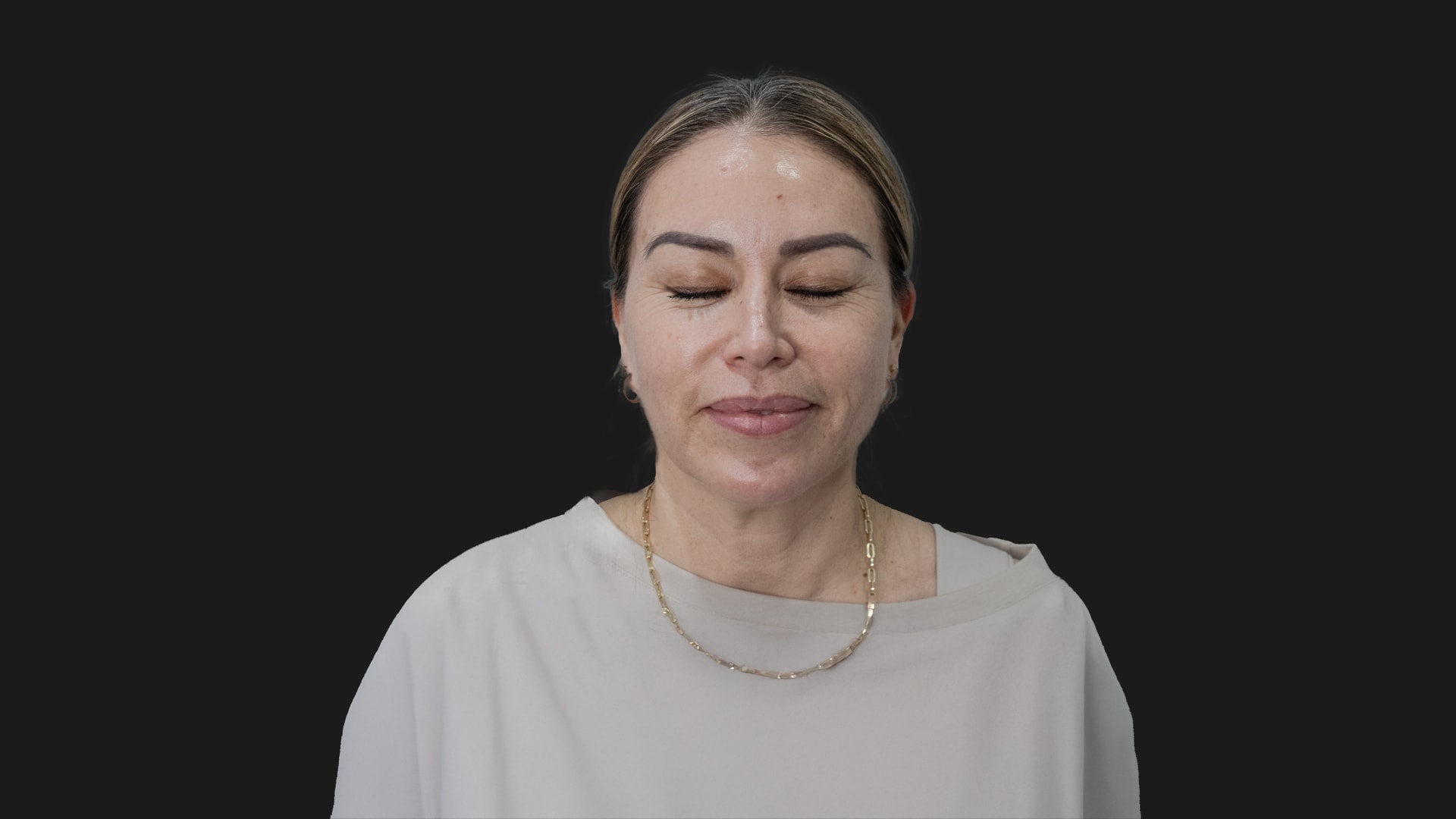 Radiofrequency Microneedling (Sylfirm X) Before