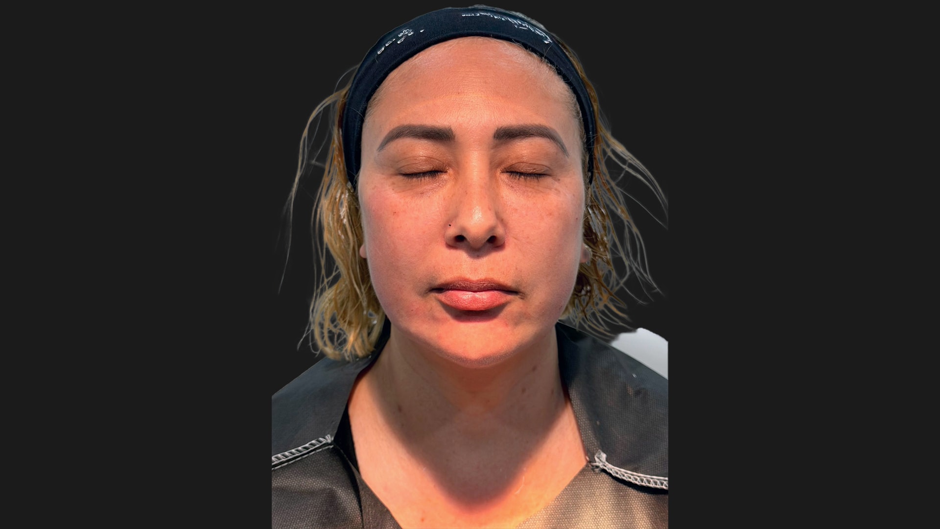 Radiofrequency Microneedling (Sylfirm X) After