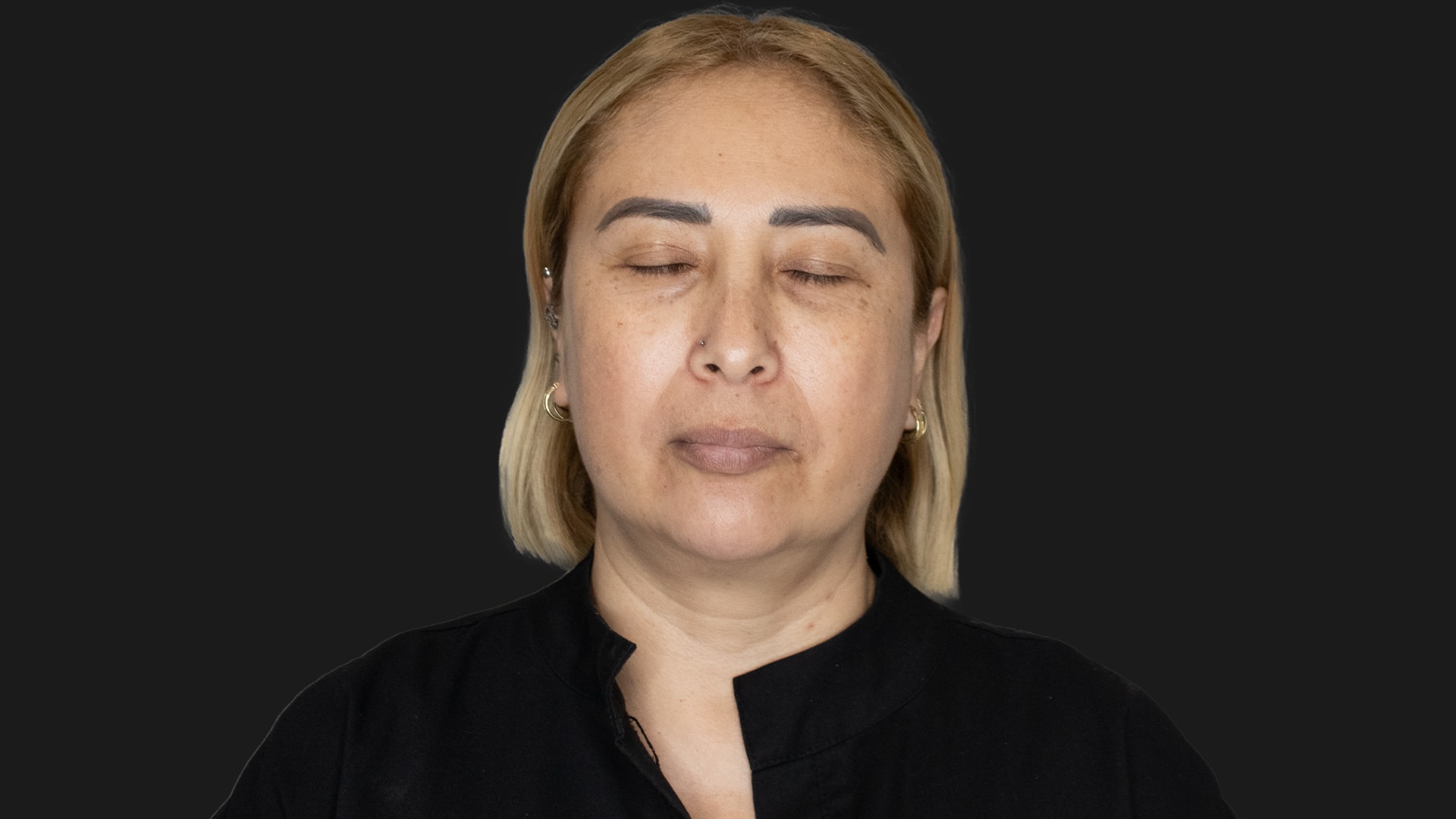 Radiofrequency Microneedling (Sylfirm X) Before