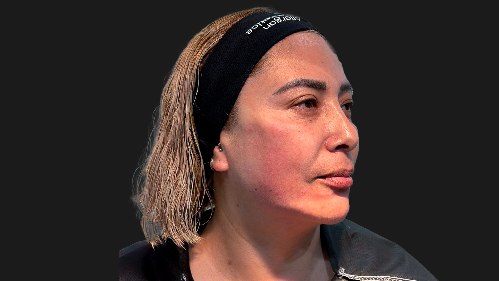 Radiofrequency Microneedling (Sylfirm X) After