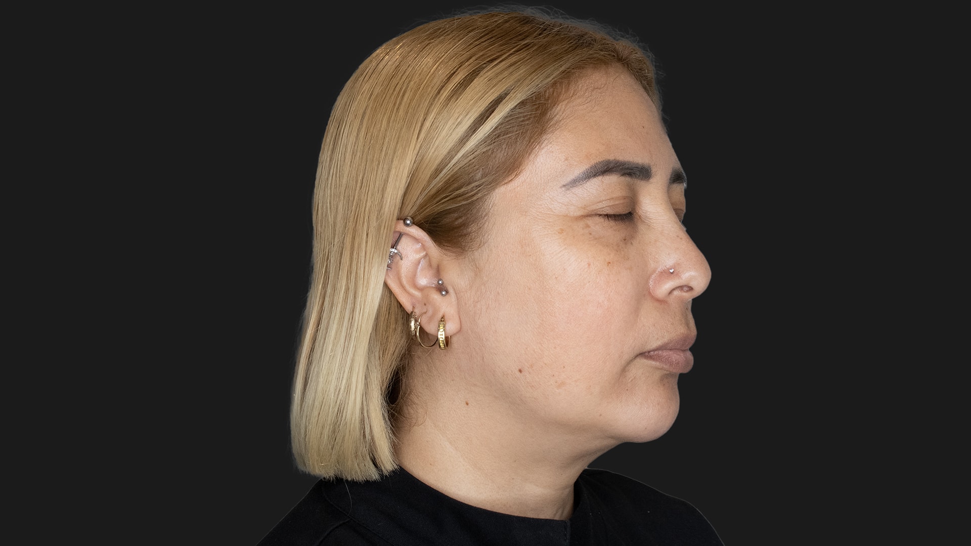 Radiofrequency Microneedling (Sylfirm X) Before